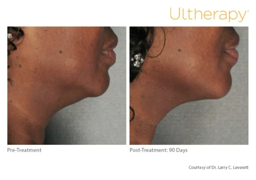 Before and 90 days after ultherapy